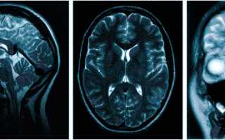 Если часто болит голова какое мрт лучше