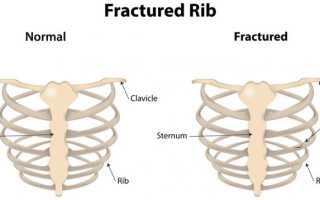Болит спина перелом ребра