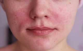 При беременности горят щеки и болит голова