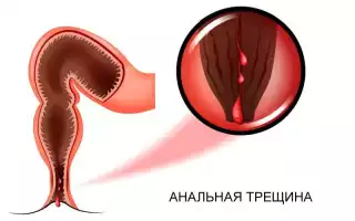 Болит спина хожу в туалет с кровью