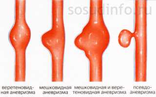 При аневризме где болит голова