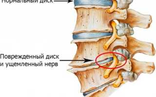 Причина болей в спине при лежании