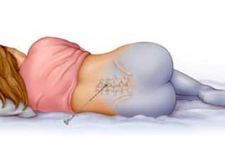 Болит спина после эа