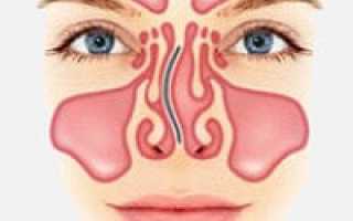 Искривленная носовая перегородка болит голова