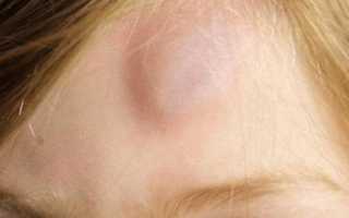 Шишка на макушке головы у взрослого болит