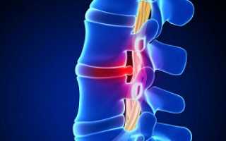 Как болит спина при грыже и температура