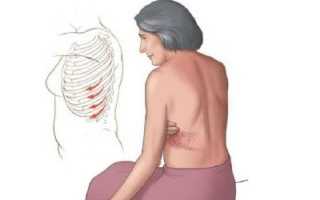 Что болит внизу ребра со спины