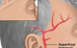 Третий день болит голова в области правого виска