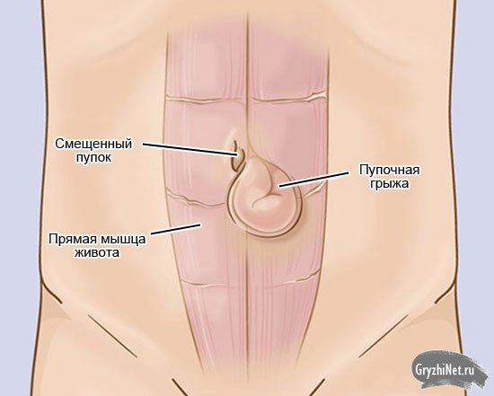 пупочная грыжа