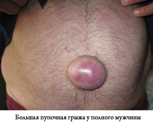пупочная грыжа