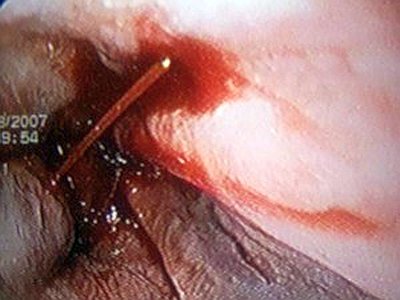 Что болит внизу ребра со спины