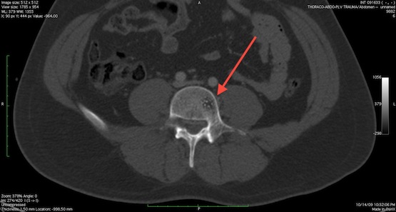 Аневризматическая костная киста