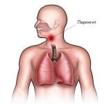 Чем характерен ларингит