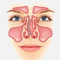 Искривленная носовая перегородка болит голова