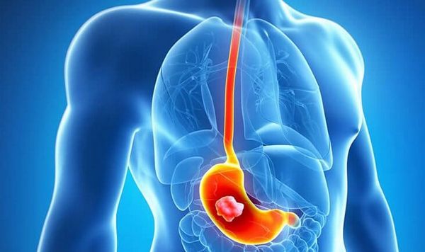 Язва желудка – одна из частых причин боли в животе