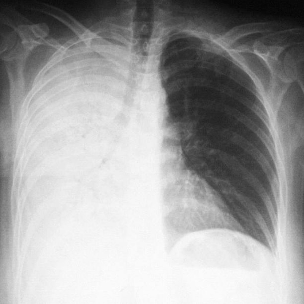 Что может болеть слева внизу спины у женщин