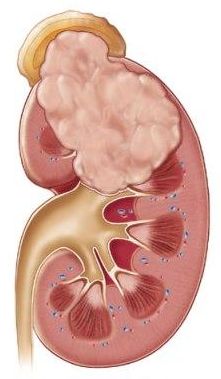 При ходьбе болит спина справа