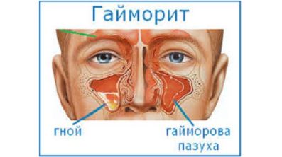 Сильная утомляемость болит голова