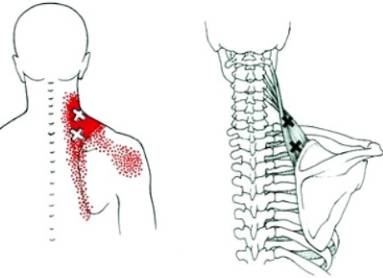 болит спина ниже лопаток причины