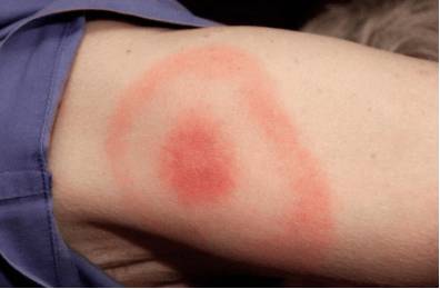 Сильная утомляемость болит голова