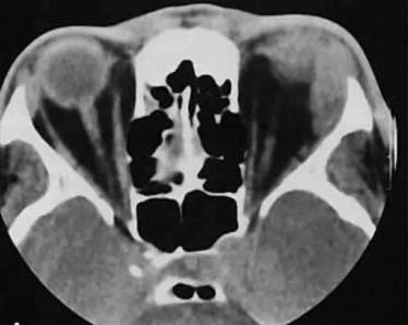 Что за симптомы когда болит спина и температура