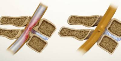 При ходьбе болит спина справа