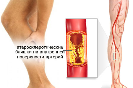 Атеросклероз