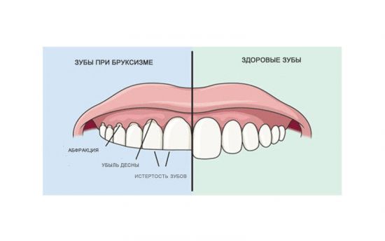 Зубы при бруксизме