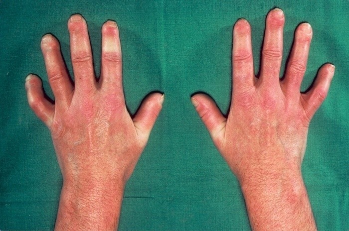 Системная склеродермия