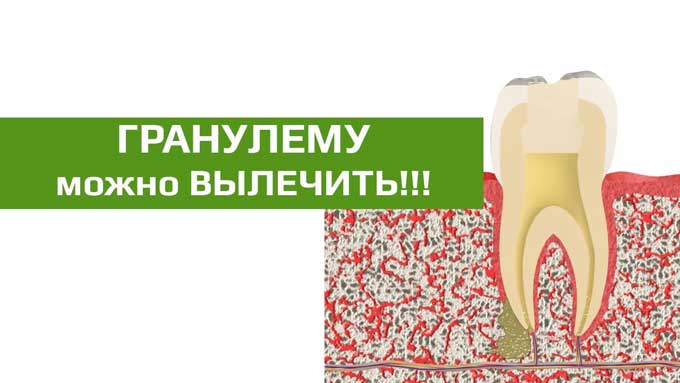 гранулема корня зуба