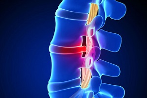 Почему поднимается температура при межпозвоночной грыже Почему поднимается температура при межпозвоночной грыже