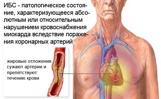 ишемия сердца