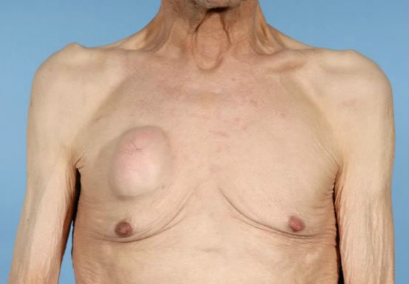 Под ребром на спине уплотнение и болит