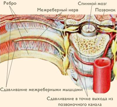 Межрёберная невралгия – возможная причина онемения спины