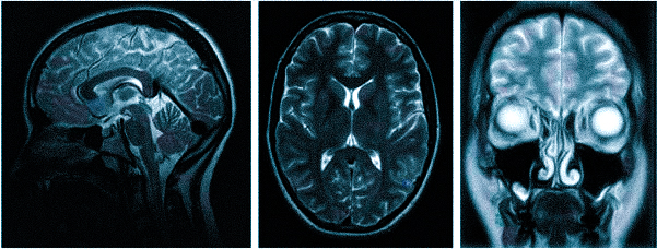 МРТ при головных болях (в трех проекциях): специальная программа выстраивает объемные изображения полученных срезов, что позволяет увидеть даже мельчайшие изменения и отдифференцировать патологию от нормы   