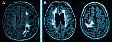 Множественные ишемические очаги при сосудистой деменции на МРТ: отсутствие памяти на недавние события и неадекватное поведение не являются признаками старости, своевременная диагностика деменции и патогенетическая терапия помогут замедлить прогрессирование болезни