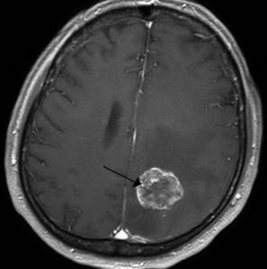 Сильная утомляемость болит голова