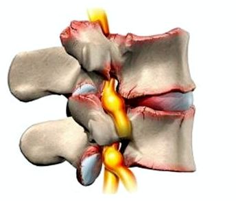 При ходьбе болит спина справа