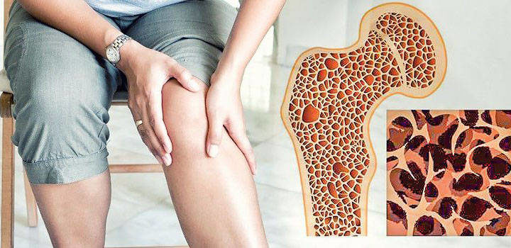 Остеопороз