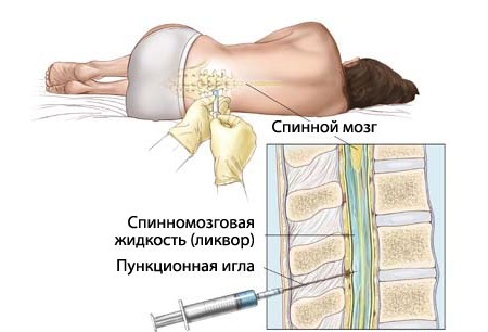 Проведение люмбальной пункции