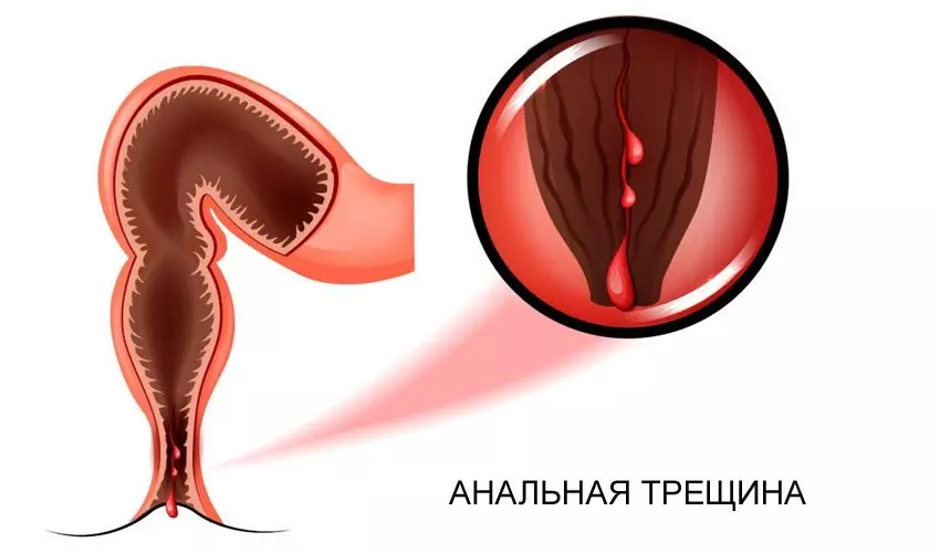 анальная трещина