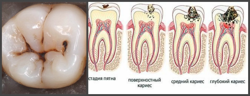 Стадии кариеса.
