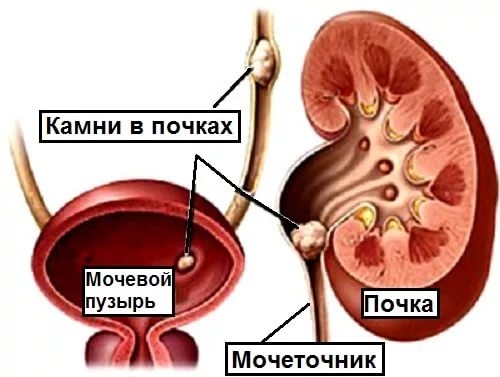 Основные симптомы камней в почках у мужчин