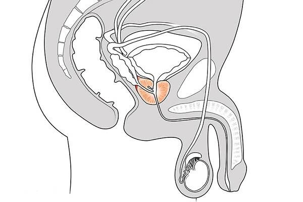 adenoma-prostaty-10.jpg adenoma-prostaty-10