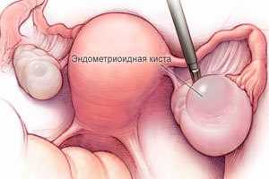 endometrioidnaya-kista.jpg