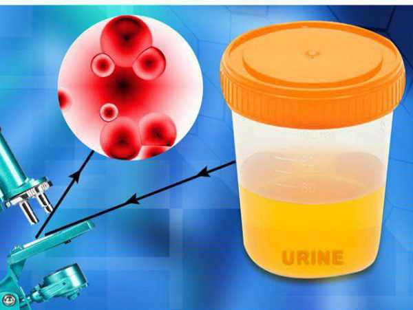 hematuria_1_16130009-e1516107722320.jpg