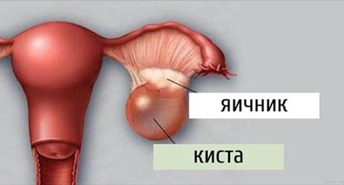 Как лечить функциональную кисту яичника: рекомендации врачей