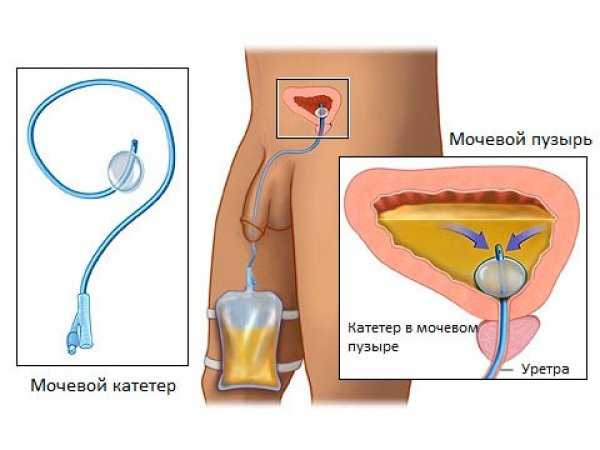 mochevoj-kateter.jpg